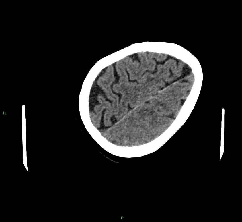 Cerebral amyloid angiopathy-associated lobar intracerebral hemorrhage (Radiopaedia 58757-65979 Axial non-contrast 116).jpg