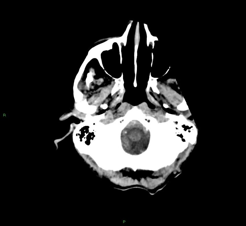 Cerebral amyloid angiopathy-associated lobar intracerebral hemorrhage (Radiopaedia 58758-65980 Axial non-contrast 45).jpg