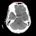 Cerebral and orbital tuberculomas (Radiopaedia 13308-13310 B 10).jpg