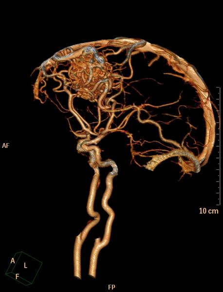 File:Cerebral arteriovenous malformation (Radiopaedia 29531-30031 B 17).jpg