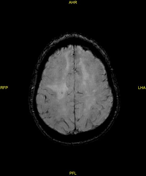 File:Cerebral autosomal dominant arteriopathy with subcortical infarcts and leukoencephalopathy (CADASIL) (Radiopaedia 86108-102054 Axial SWI 81).jpg