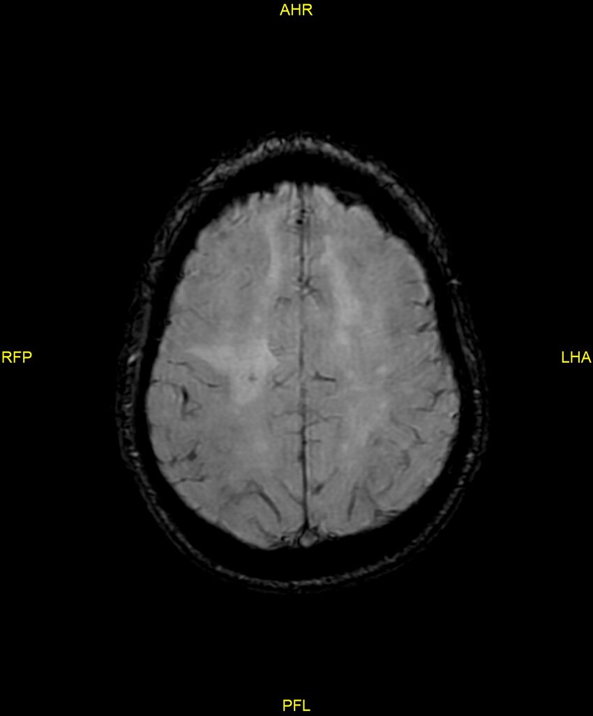 Cerebral autosomal dominant arteriopathy with subcortical infarcts and leukoencephalopathy (CADASIL) (Radiopaedia 86108-102054 Axial SWI 81).jpg