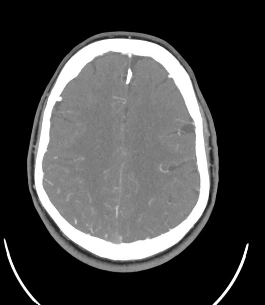 File:Cerebral dural venous sinus thrombosis (Radiopaedia 86514-102576 A 70).jpg