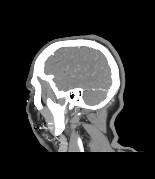 File:Cerebral dural venous sinus thrombosis (Radiopaedia 86514-102576 C 6).jpg