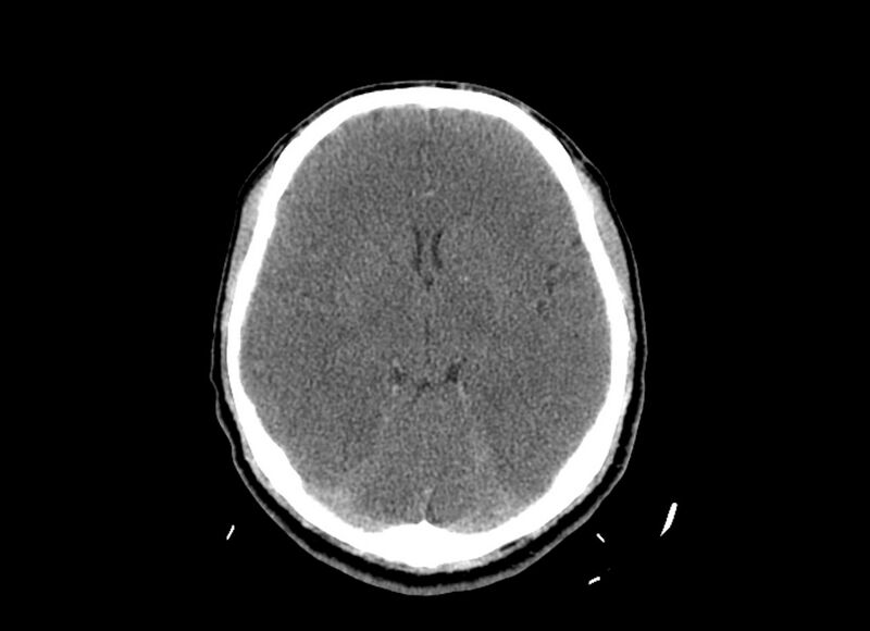 File:Cerebral edema (Radiopaedia 82519-96661 Axial non-contrast 30).jpg