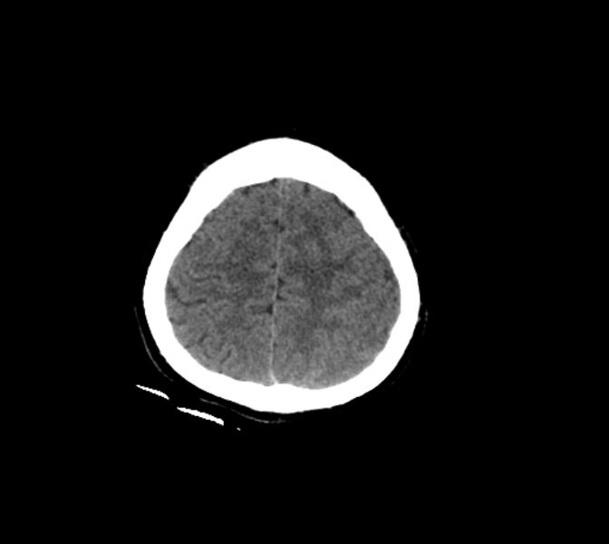 File:Cerebral fat embolism (Radiopaedia 37510-39362 Axial non-contrast 28).jpg