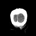Cerebral hemorrhagic contusions (Radiopaedia 23145-23188 Coronal non-contrast 41).jpg