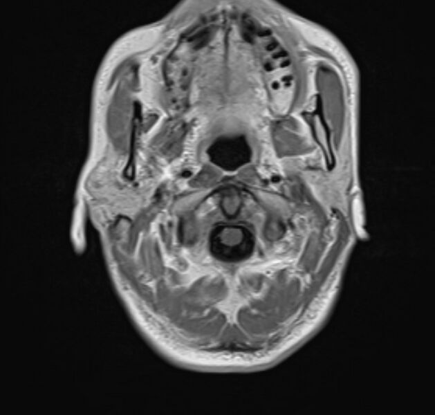 File:Cerebral venous thrombosis (Radiopaedia 71207-81504 Axial T1 C+ 1).jpg