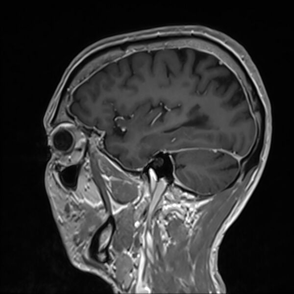 File:Cervical dural CSF leak on MRI and CT treated by blood patch (Radiopaedia 49748-54995 G 90).jpg