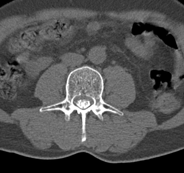 File:Cervical dural CSF leak on MRI and CT treated by blood patch (Radiopaedia 49748-54996 B 102).png