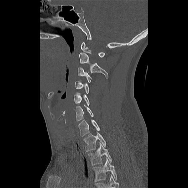 File:Cervical facet fracture and anterior discoligamentous injury (Radiopaedia 32139-33083 Sagittal bone window 24).jpg