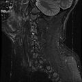 Cervical flexion teardrop fracture with cord hemorrhage (Radiopaedia 32497-33455 Sagittal STIR 17).jpg