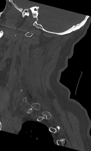 File:Cervical spine fracture - chalk stick (Radiopaedia 39116-41323 Sagittal bone window 46).png