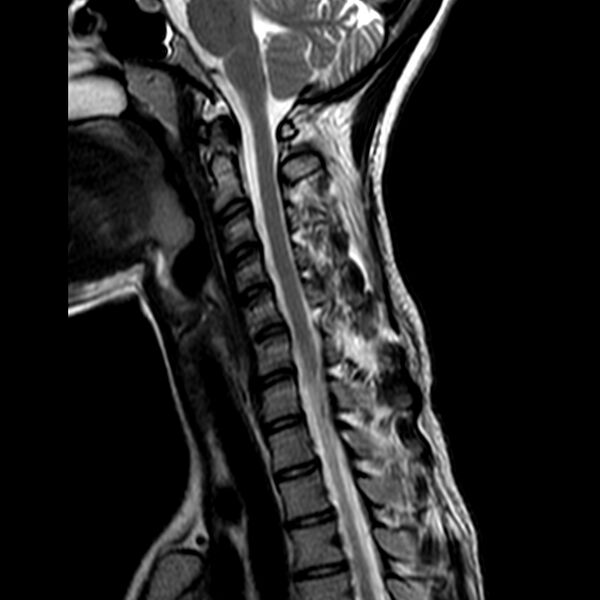 File:Cervical spine posterior ligamentous complex rupture (Radiopaedia 63486-72103 Sagittal T2 8).jpg