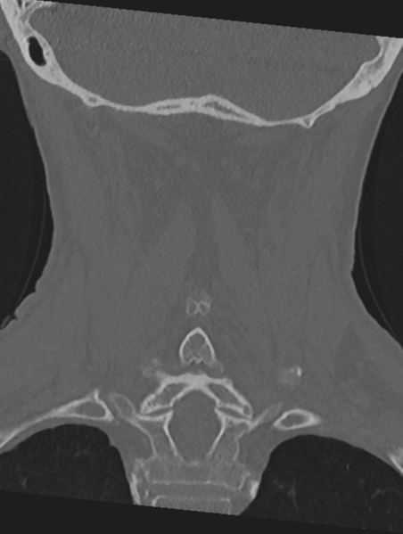 File:Cervical spondylolysis (Radiopaedia 49616-54811 Coronal bone window 41).png