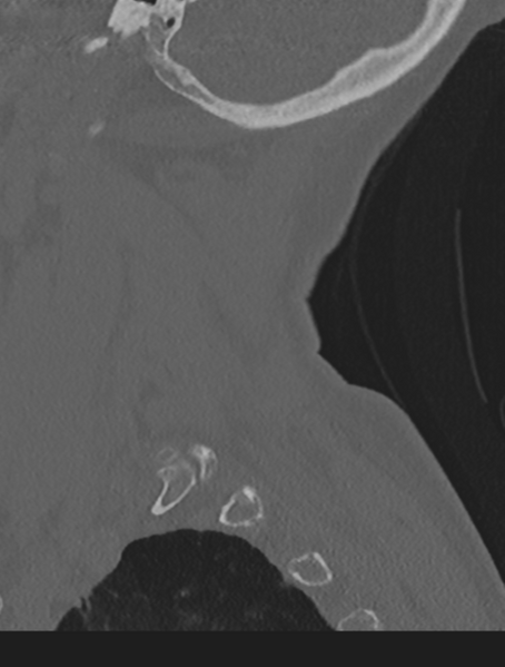 File:Cervical spondylolysis (Radiopaedia 49616-54811 Sagittal bone window 62).png