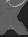 Cervical spondylolysis (Radiopaedia 49616-54811 Sagittal bone window 62).png