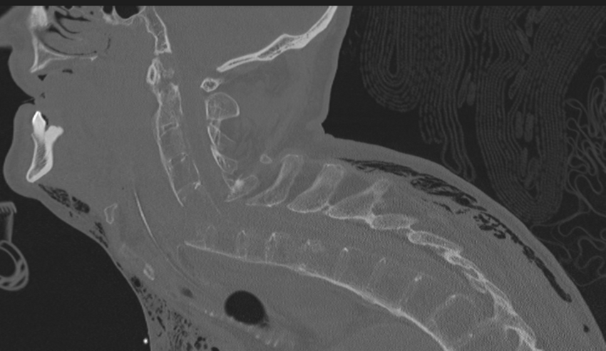 Chalk stick fracture (Radiopaedia 57948-64928 Sagittal bone window 29).png