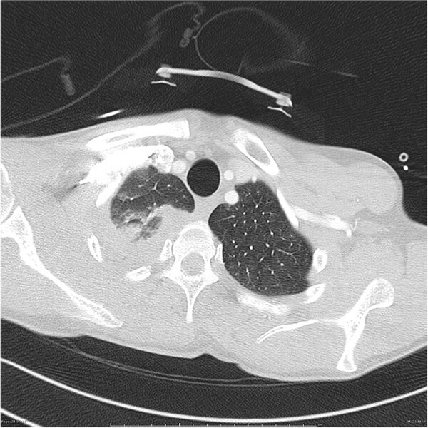 File:Chest and abdomen multi-trauma (Radiopaedia 26294-26425 lung window 21).jpg