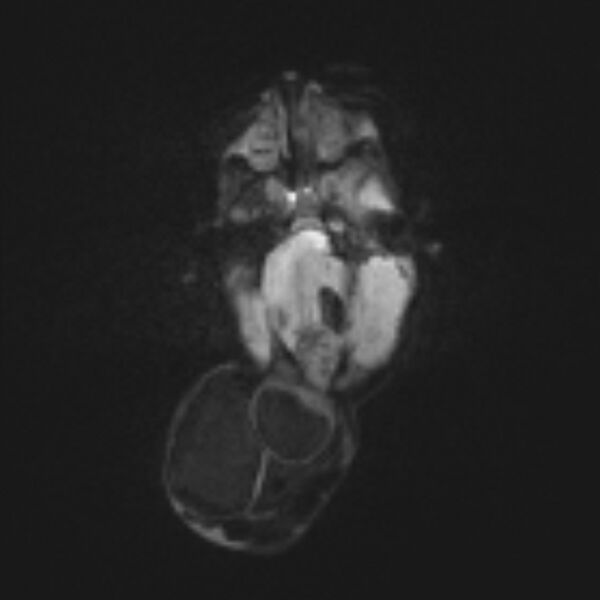 File:Chiari III malformation with occipital encephalocele (Radiopaedia 79446-92559 Axial DWI 29).jpg