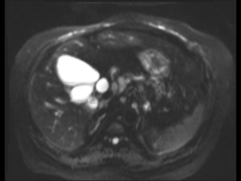 File:Choledocholithiasis causing intrahepatic biliary duct dilation (Radiopaedia 39908-42369 Axial T2 SPAIR 19).jpg