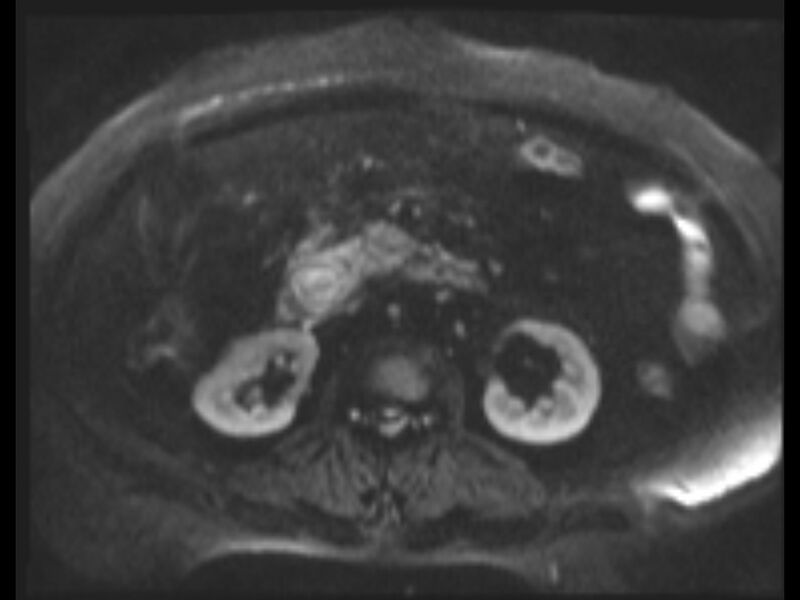 File:Choledocholithiasis causing intrahepatic biliary duct dilation (Radiopaedia 39908-42369 Axial T2 SPAIR 29).jpg