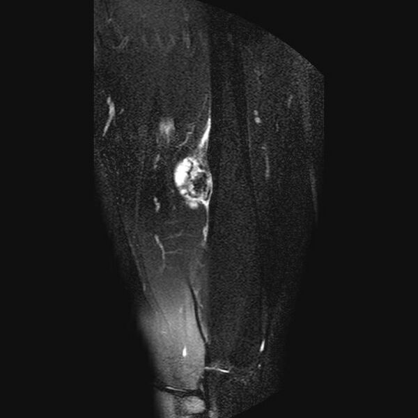 File:Chondrosarcoma arising from exostosis (Radiopaedia 59996-67686 C 10).jpg