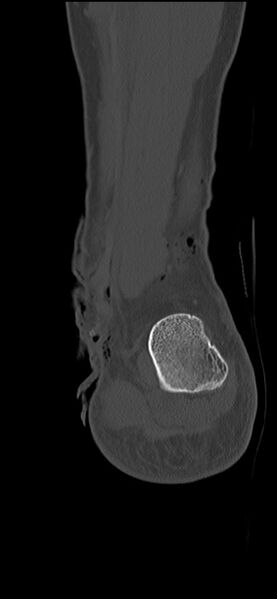 File:Chopart fracture (Radiopaedia 35347-36851 Coronal bone window 16).jpg