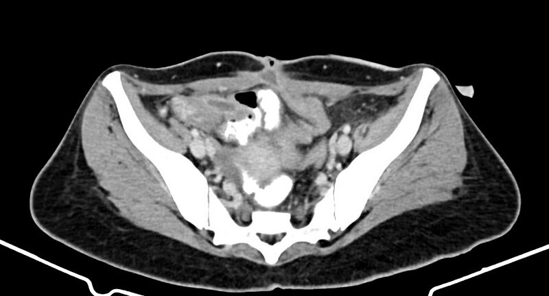 File:Choriocarcinoma liver metastases (Radiopaedia 74768-85766 A 167).jpg