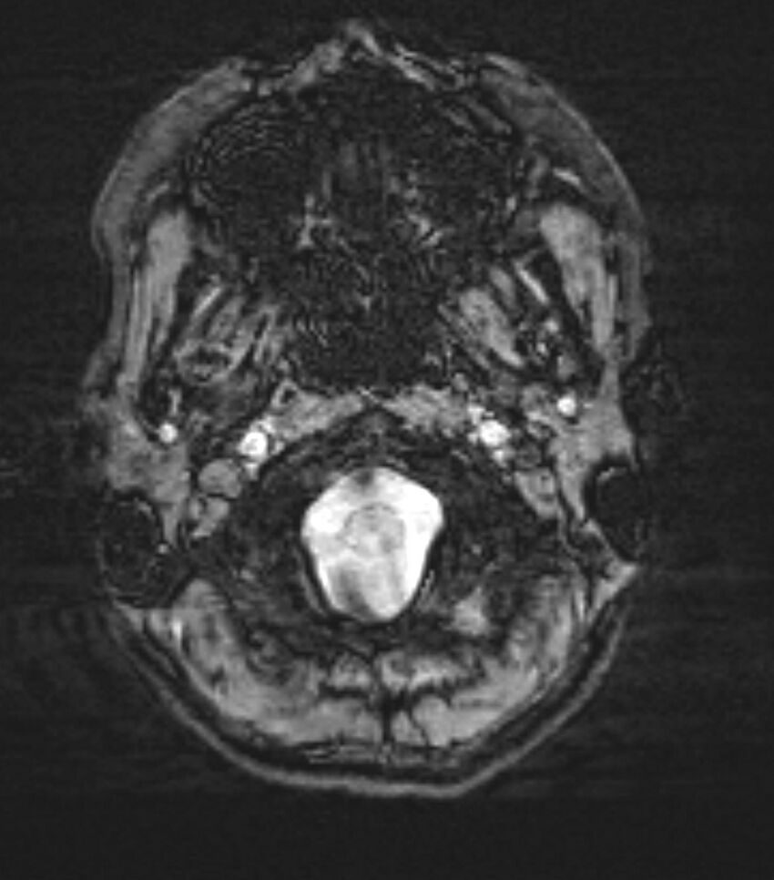 Choroid plexus carcinoma (Radiopaedia 91013-108553 Axial SWI 7).jpg