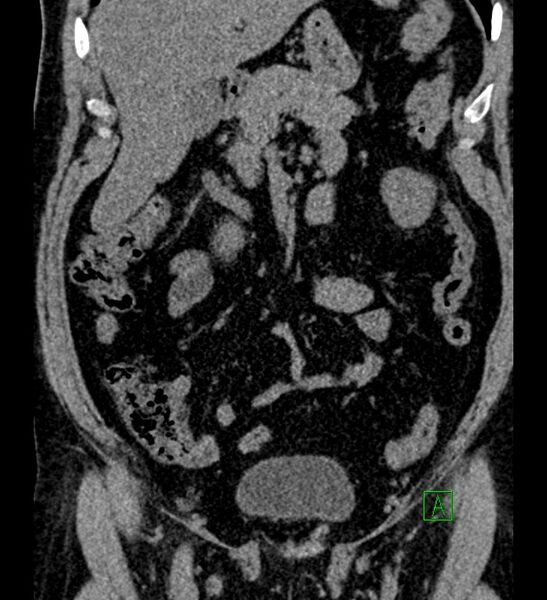File:Chromophobe renal cell carcinoma (Radiopaedia 84286-99573 Coronal non-contrast 65).jpg