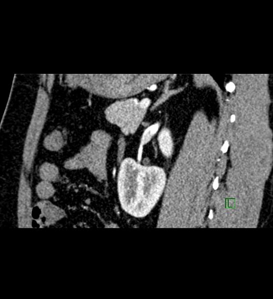 File:Chromophobe renal cell carcinoma (Radiopaedia 84286-99573 F 60).jpg