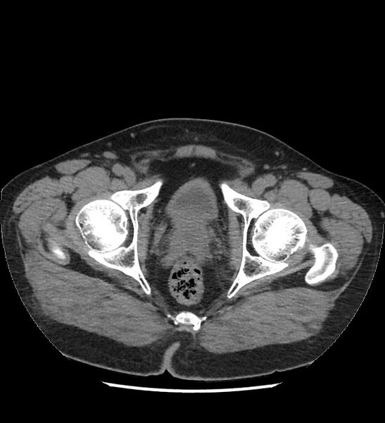 File:Chromophobe renal cell carcinoma (Radiopaedia 86879-103083 Axial non-contrast 126).jpg
