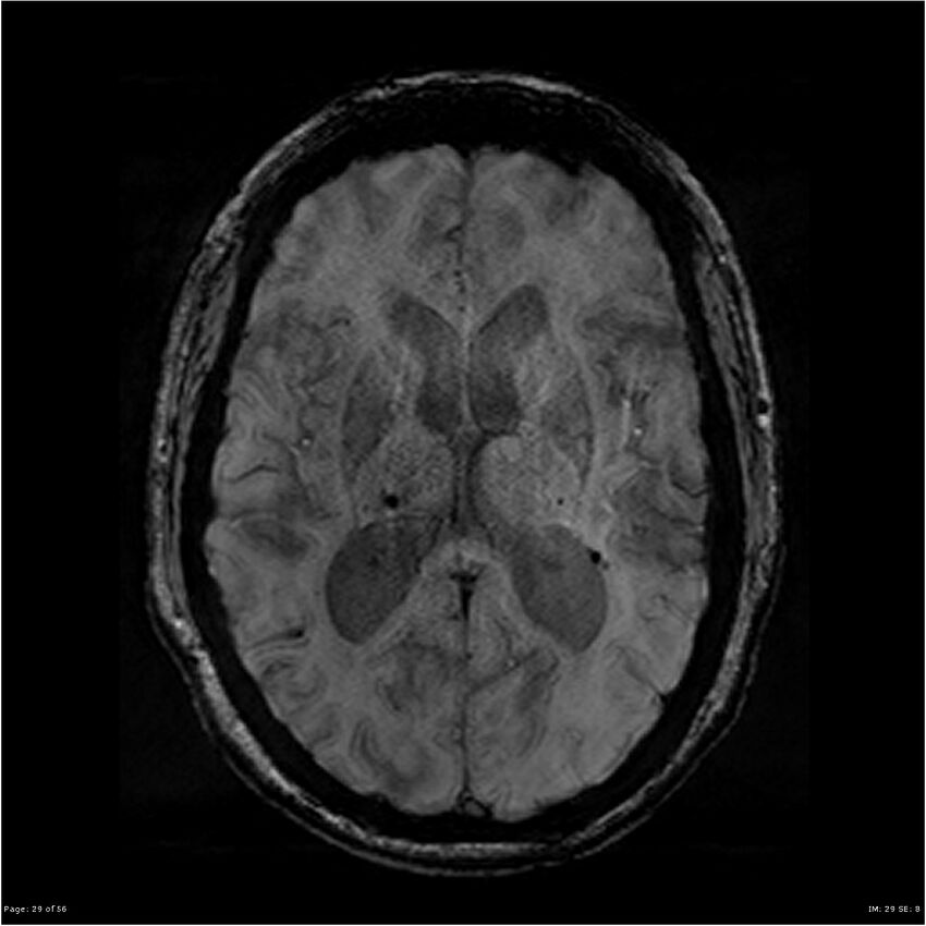 Chronic hypertensive encephalopathy (Radiopaedia 25764-25918 Axial SWI 29).jpg