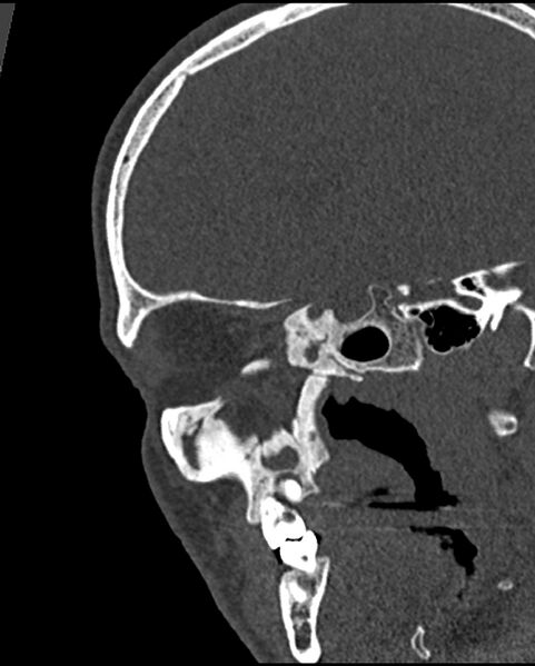 File:Chronic maxillary sinusitis caused by a foreign body (Radiopaedia 58521-65676 Sagittal bone window 48).jpg