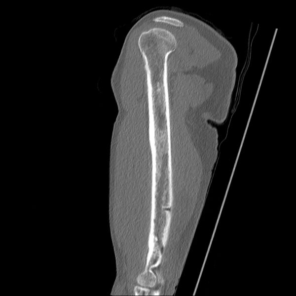 File:Chronic osteomyelitis (Radiopaedia 67597-76998 Sagittal bone window 14).jpg