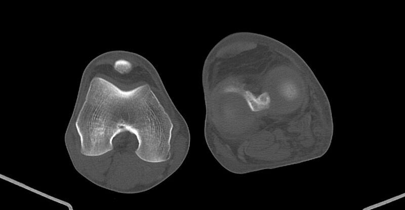 File:Chronic osteomyelitis (with sequestrum) (Radiopaedia 74813-85822 Axial non-contrast 189).jpg