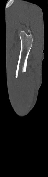File:Chronic osteomyelitis (with sequestrum) (Radiopaedia 74813-85822 C 97).jpg