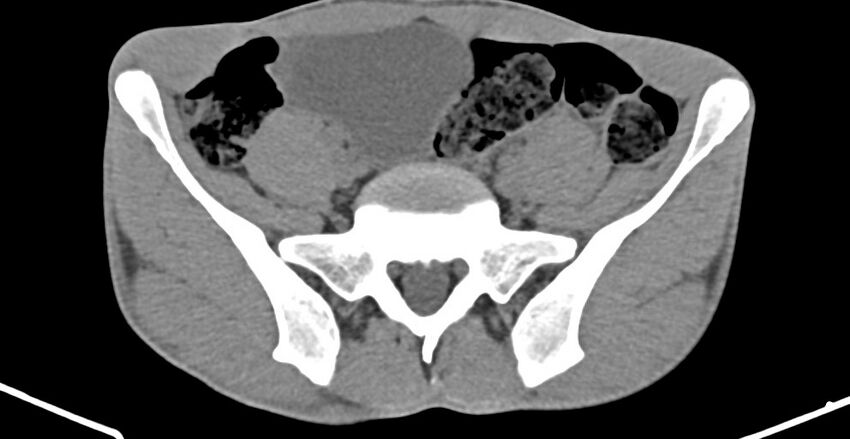 Chronic osteomyelitis (with sequestrum) (Radiopaedia 74813-85822 D 2).jpg