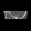 Chronic otomastoiditis (Radiopaedia 27138-27309 Sagittal bone window 7).jpg