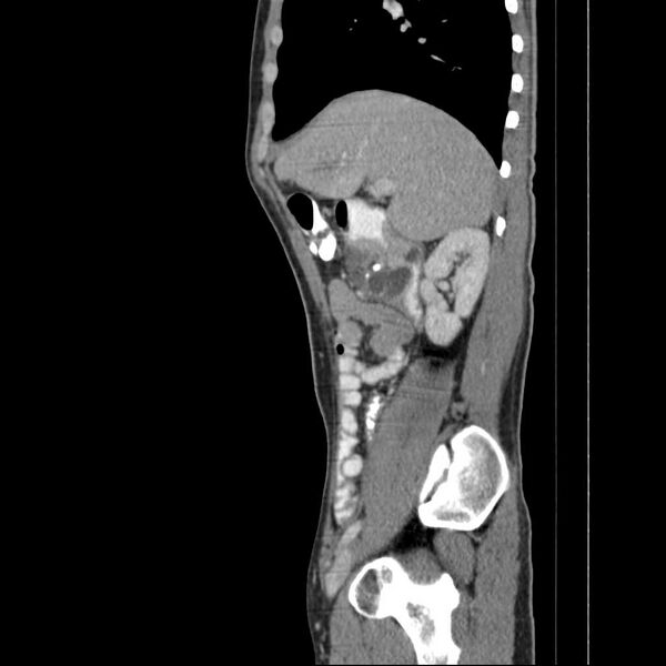 File:Chronic pancreatitis (Radiopaedia 21022-20949 D 14).jpg