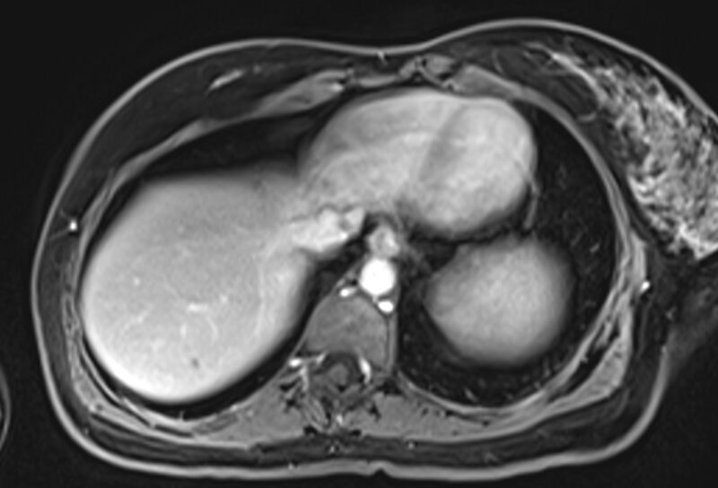 File:Chronic pancreatitis - pancreatic duct calculi (Radiopaedia 71818-82250 Axial T1 C+ fat sat 5).jpg