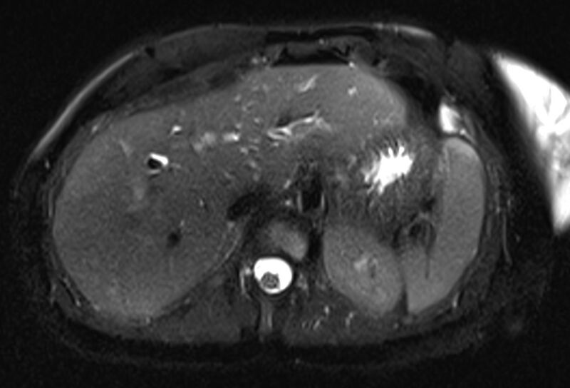 File:Chronic pancreatitis - pancreatic duct calculi (Radiopaedia 71818-82250 Axial T2 fat sat 16).jpg