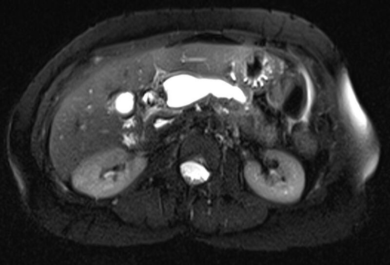 File:Chronic pancreatitis - pancreatic duct calculi (Radiopaedia 71818-82250 Axial T2 fat sat 30).jpg