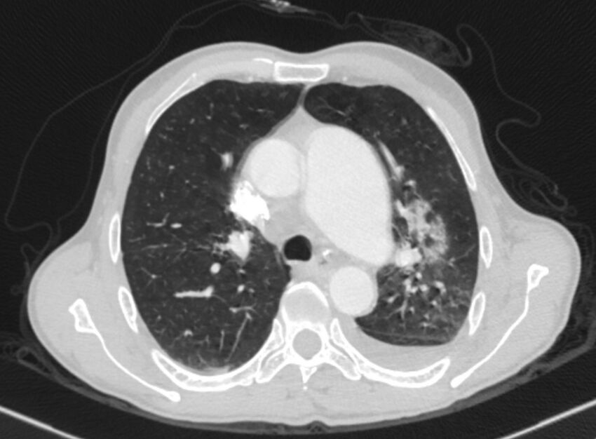 Chronic pulmonary embolism with bubbly consolidation (Radiopaedia 91248-108850 Axial lung window 57).jpg