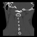 Clay-shoveler fracture (Radiopaedia 22568-22590 Coronal bone window 27).jpg