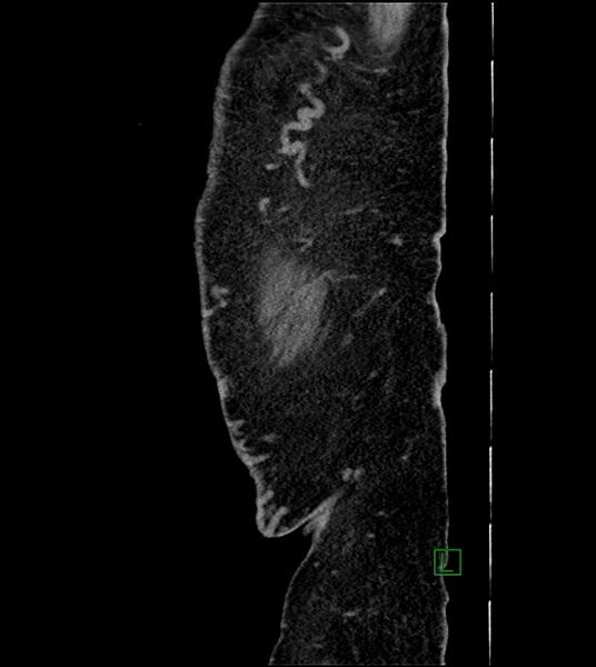 File:Closed-loop small bowel obstruction-internal hernia (Radiopaedia 78439-91096 C 12).jpg