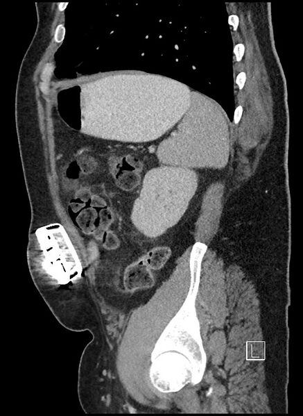 File:Closed loop obstruction - internal hernia into nephrectomy bed (Radiopaedia 59867-67320 C 15).jpg