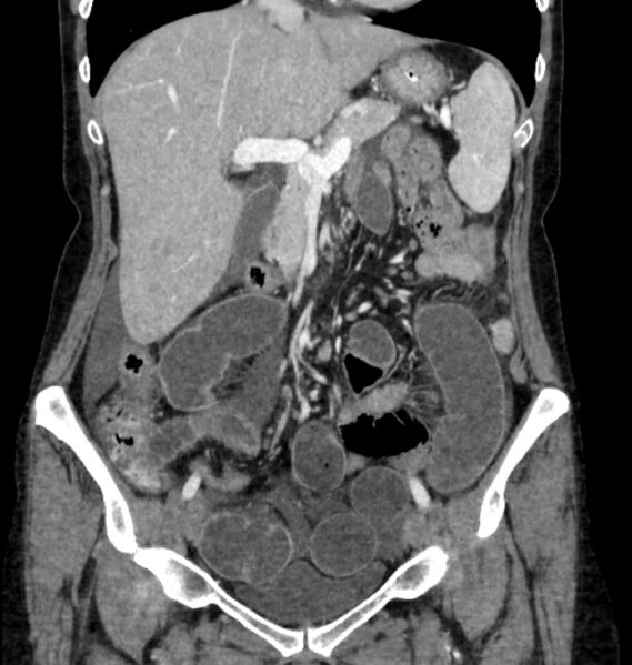 File:Closed loop small bowel obstruction (Radiopaedia 71211-81508 B 43).jpg