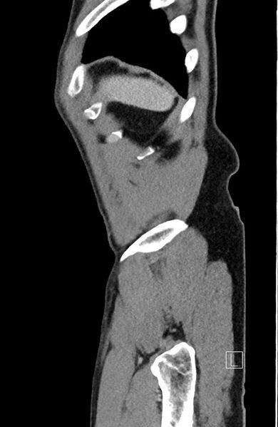 File:Closed loop small bowel obstruction - internal hernia (Radiopaedia 57806-64778 C 14).jpg